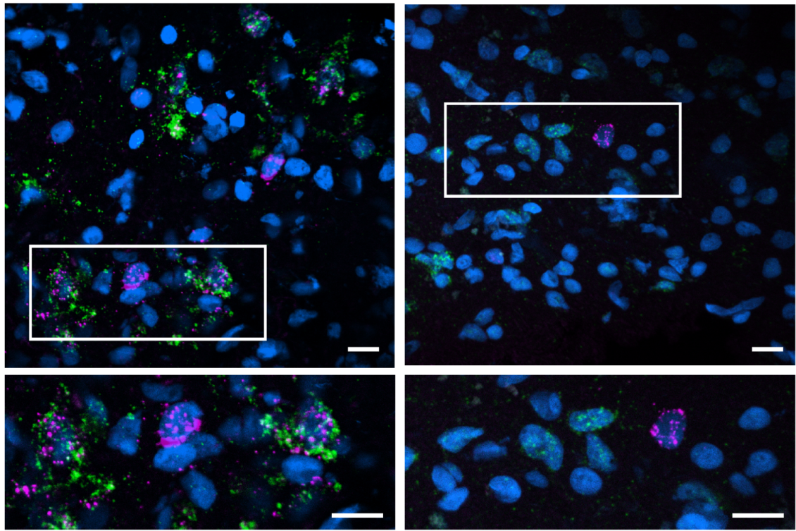 Study across multiple brain regions discerns Alzheimer’s vulnerability and resilience factors